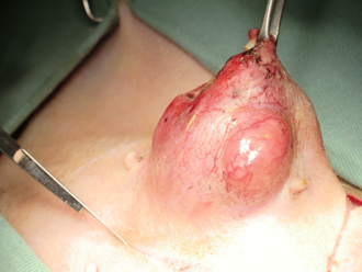 乳腺腫瘍摘出術